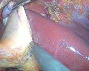 Colecistectomía laparoscópica