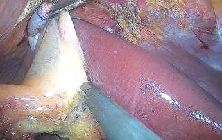 Colecistectomía laparoscópica